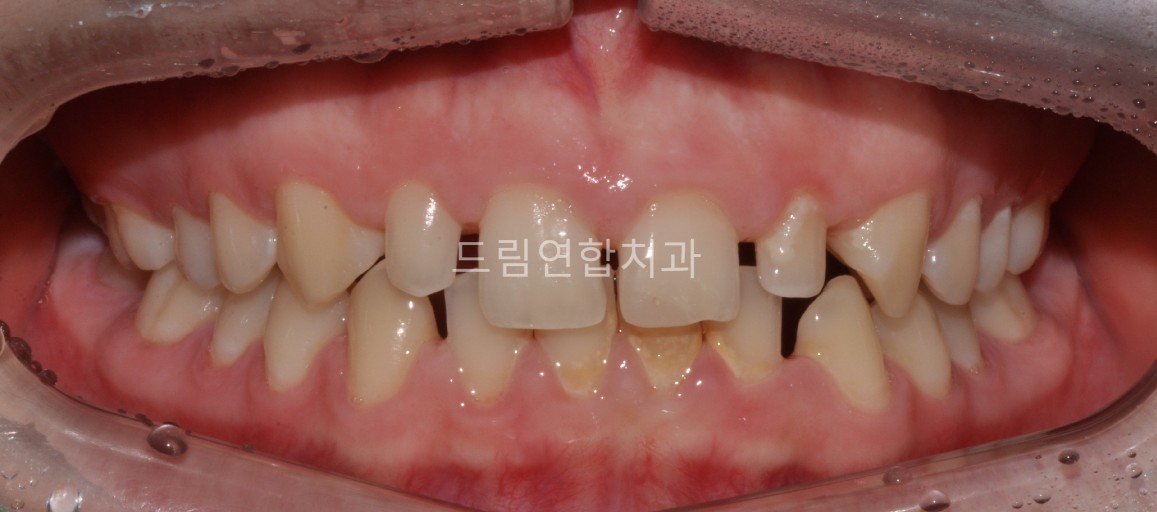 울산 교정 치과 추천 드림연합치과 보철 전 교정 항목별 구성 왜소치 교정 (Microdontia Correction) 문제: 치아가 정상보다 작아 주변 치아와 비율이 맞지 않음. 영향: 인접 치아가 틀어지거나 치아 사이에 공간이 생겨 보철물 제작이 어려움. 치료 방법: 교정 장치를 통해 인접 치아를 이동시켜 보철물 제작 공간 확보. 크기가 작은 치아에는 라미네이트나 크라운으로 심미성 보완. 예시 사례: 왜소치와 인접 치아 배열 교정 후 보철물 제작 성공 사례. 결과: 전체교정으로 치아 사이 공간 전부 닫길 권유드렸으나, 시간적 측면으로 부분교정 선택. 환자 실제 사례 교정 전 사진