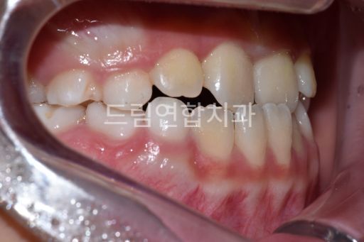 울산 교정 잘하는 치과 아래턱이 윗턱보다 과도하게 성장하여 주걱턱이 발생한 사례 교정 전 측면1