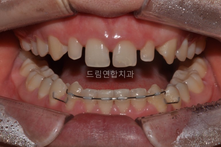 울산 교정 치과 추천 드림연합치과 보철 전 교정 항목별 구성 왜소치 교정 (Microdontia Correction) 문제: 치아가 정상보다 작아 주변 치아와 비율이 맞지 않음. 영향: 인접 치아가 틀어지거나 치아 사이에 공간이 생겨 보철물 제작이 어려움. 치료 방법: 교정 장치를 통해 인접 치아를 이동시켜 보철물 제작 공간 확보. 크기가 작은 치아에는 라미네이트나 크라운으로 심미성 보완. 예시 사례: 왜소치와 인접 치아 배열 교정 후 보철물 제작 성공 사례. 결과: 전체교정으로 치아 사이 공간 전부 닫길 권유드렸으나, 시간적 측면으로 부분교정 선택. 환자 실제 사례 교정 중 사진