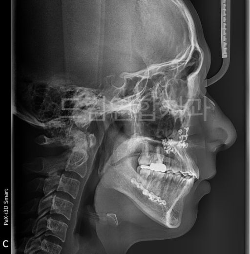 주걱턱 양악수술 포함 교정 울산 드림연합치과 치아교정 주걱턱 교정 과정 교정 후 측면 xray 사진