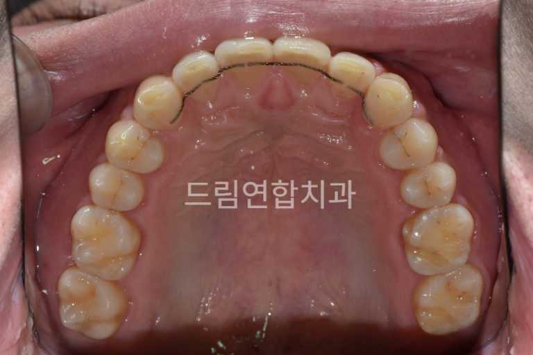 울산 교정 치과 추천 드림연합치과 유형별 교정 치아 사이 공간 부족 (Space Correction) 문제: 치아 간격이 지나치게 좁거나 공간이 부족해 맹출이 어려움. 치료: 공간 유지 장치 및 악궁 확장 장치 사용. 결과: 치아 맹출 문제 해결로 건강한 치열 유지.