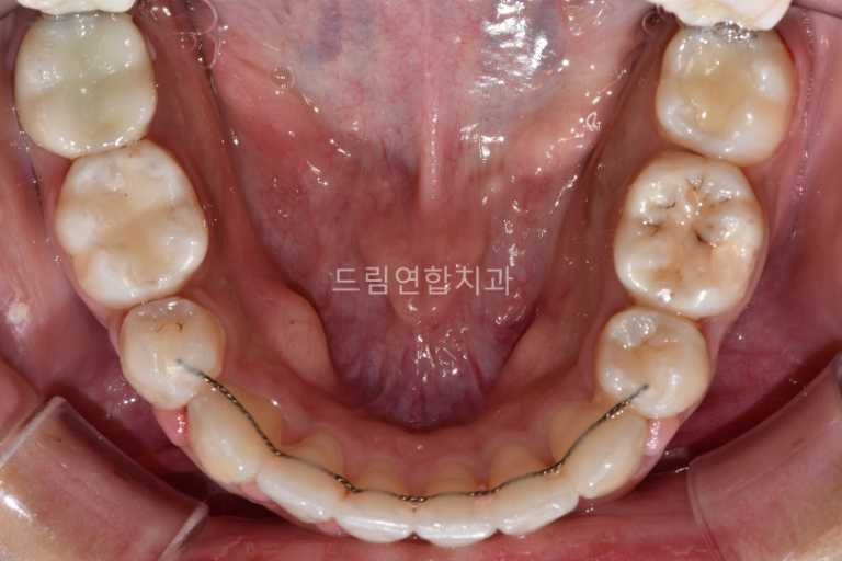 울산 교정 치과 추천 드림연합치과 유형별 교정 덧니 교정 실제 사례