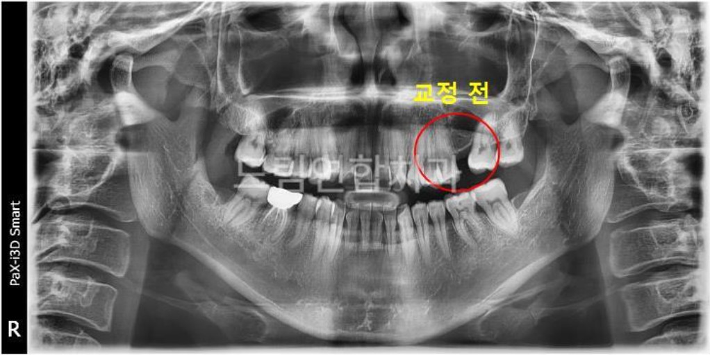 울산 교정 치과 추천 드림연합치과 보철 전 교정 항목별 구성 임플란트 교정 (Pre-Implant Orthodontics) 문제: 치아 상실 후 주변 치아가 기울거나 이동해 임플란트 식립 공간이 부족함. 영향: 임플란트 식립이 어려워지고 보철물의 안정성 저하. 치료 방법: 교정 장치를 통해 기울어진 치아를 제자리로 이동. 임플란트 식립 공간을 확보하고 교합을 개선. 예시 사례: 쓰러진 어금니를 교정해 임플란트 식립 성공 및 드림연합치과 의료진 협진 사례. 환자 실제 사례 교정 전.