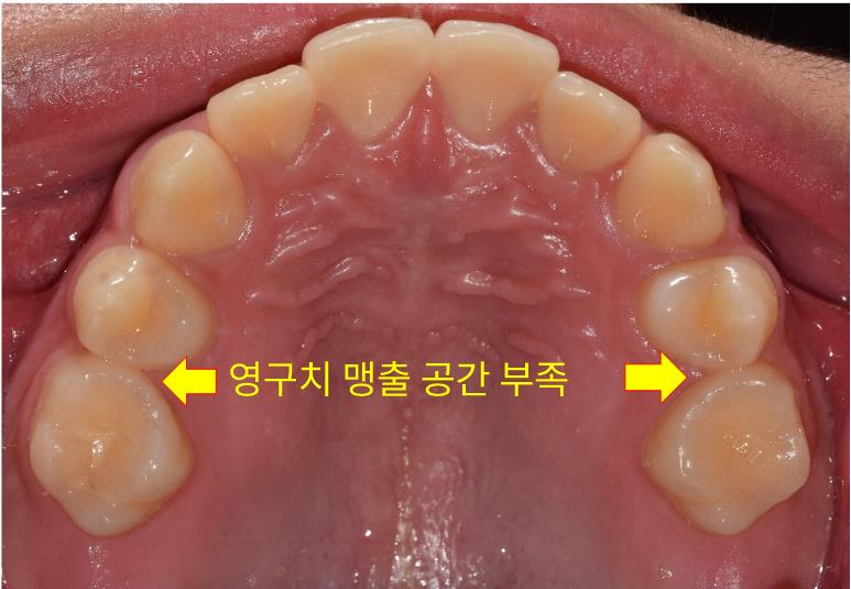 치아 맹출 공간 부족 – 정면 교정 전 사진 | 울산 교정 치과 추천