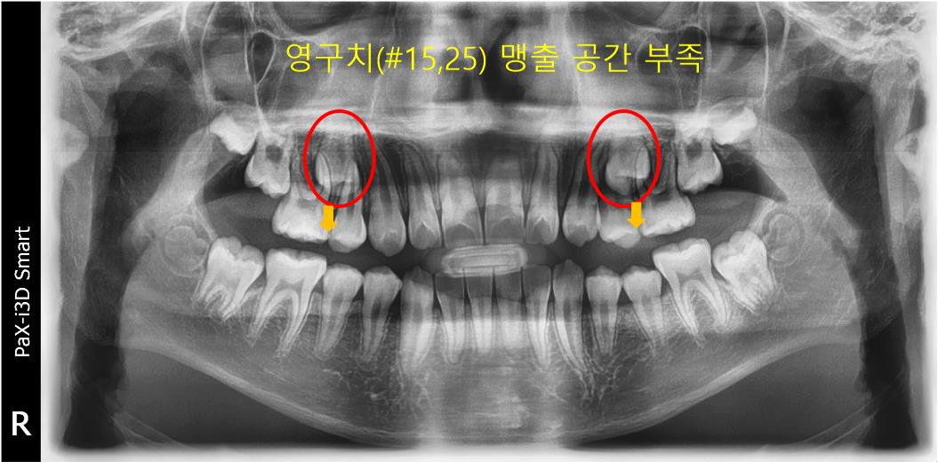 치아 맹출 공간 부족 – 교정 전 사진 | 울산 교정 치과 추천