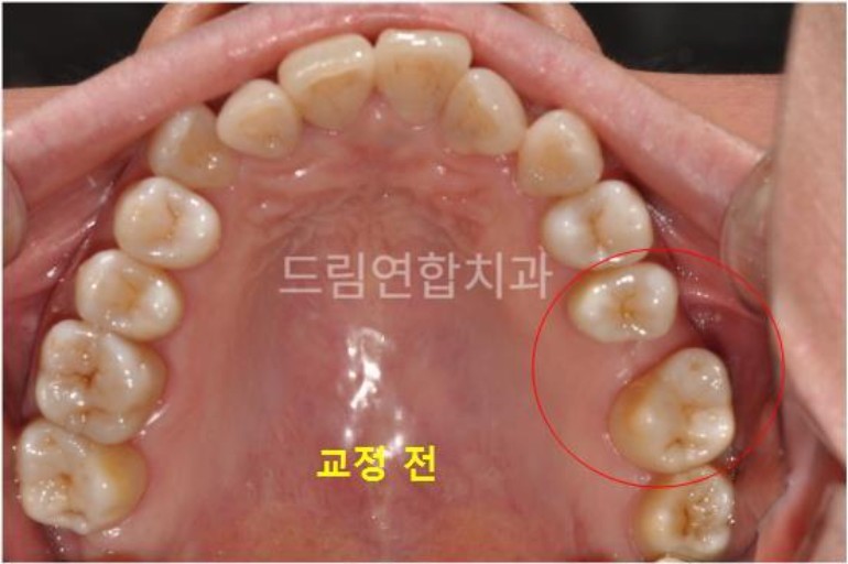 울산 교정 치과 추천 드림연합치과 보철 전 교정 항목별 구성 임플란트 교정 (Pre-Implant Orthodontics) 문제: 치아 상실 후 주변 치아가 기울거나 이동해 임플란트 식립 공간이 부족함. 영향: 임플란트 식립이 어려워지고 보철물의 안정성 저하. 치료 방법: 교정 장치를 통해 기울어진 치아를 제자리로 이동. 임플란트 식립 공간을 확보하고 교합을 개선. 예시 사례: 쓰러진 어금니를 교정해 임플란트 식립 성공 및 드림연합치과 의료진 협진 사례. 환자 실제 사례 교정 전.