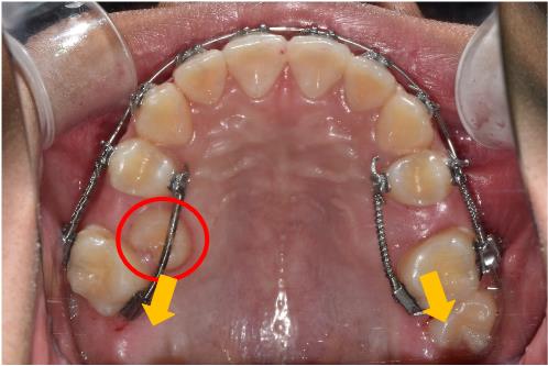 치아 맹출 공간 부족 – 교정 2번 사진 | 울산 교정 치과 추천