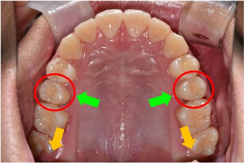 치아 맹출 공간 부족 – 교정 4번 사진 | 울산 교정 치과 추천
