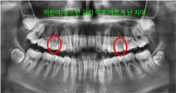 치아 맹출 공간 확보 완료 – 좌측 교정 후 사진 | 울산 교정 치과 추천