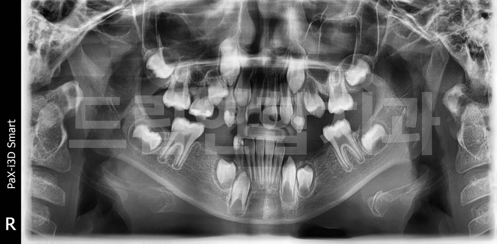 울산 교정 잘하는 치과 어린이 예방 교정 드림연합치과 영구치 missing px xray