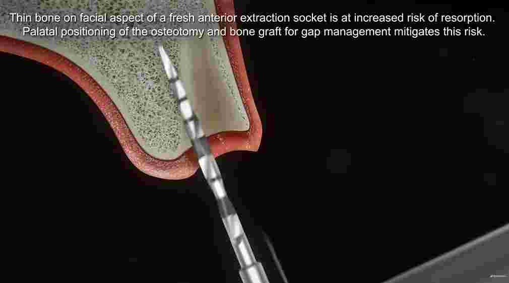 앞니 임플란트 수술 중 치조골 드릴링 모습