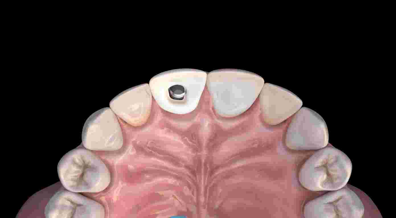 앞니 임플란트의 정확한 식립을 위한 가이드 스텐트 사용