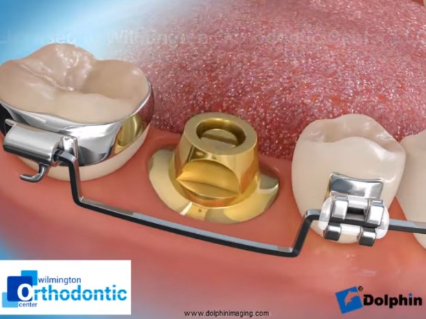 울산 임플란트 교정을 위한 완벽 가이드 Molar Uprighting for Implant 7