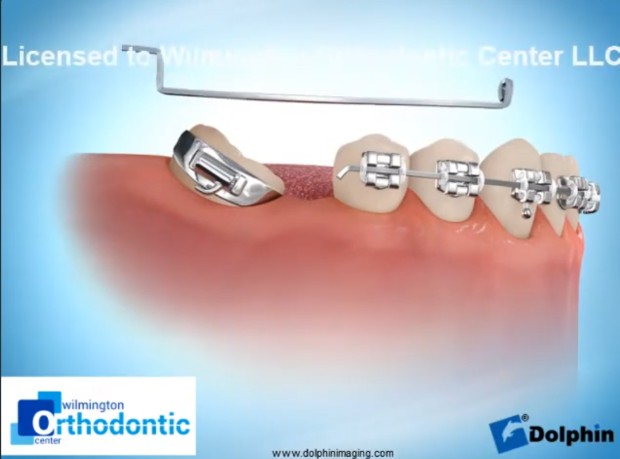 울산 임플란트 교정을 위한 완벽 가이드 Molar Uprighting for Implant