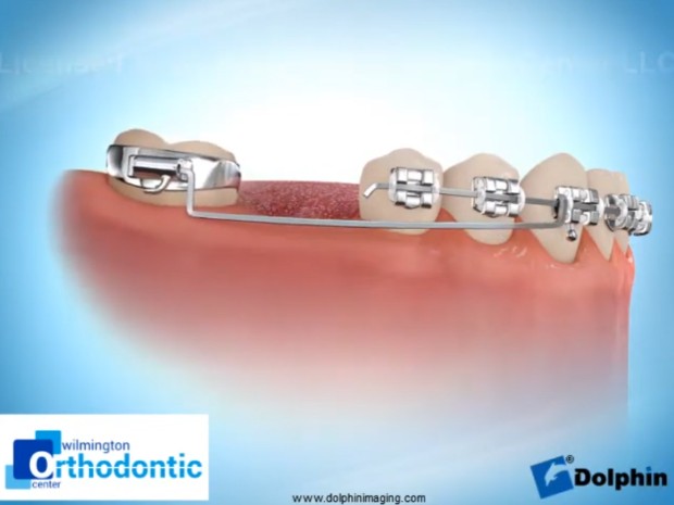 울산 임플란트 교정을 위한 완벽 가이드 Molar Uprighting for Implant 3