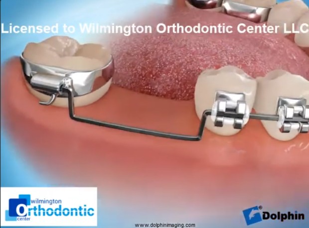 울산 임플란트 교정을 위한 완벽 가이드 Molar Uprighting for Implant 4