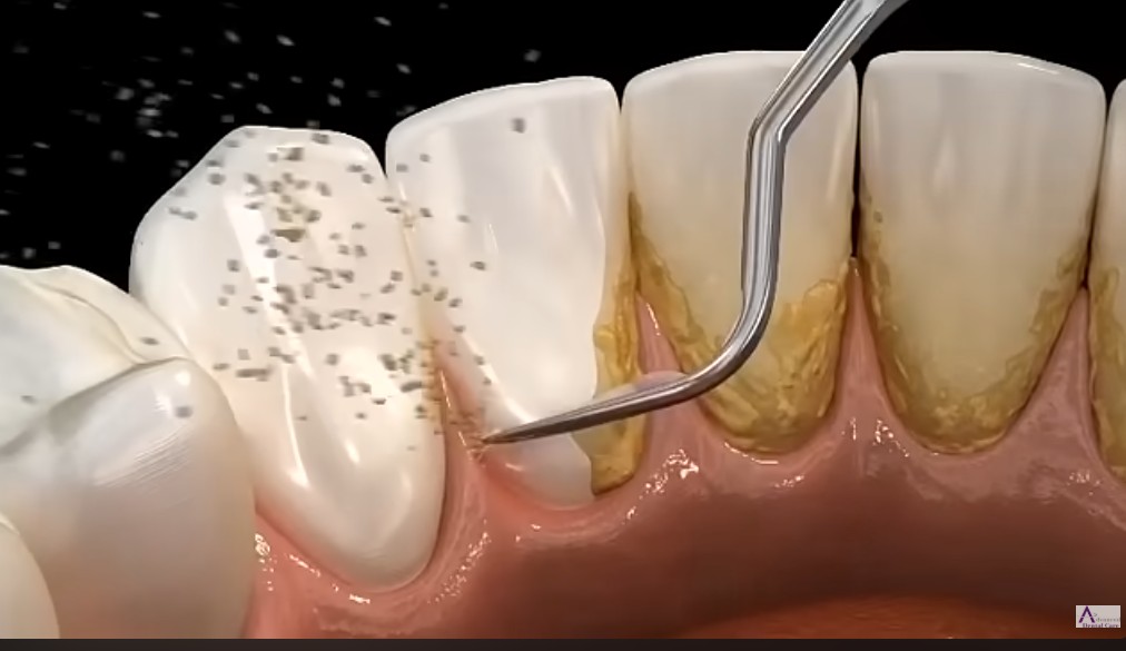 스케일링의 과정 플라그가 껴있는 사진 (출처 Advanced Dental Care)