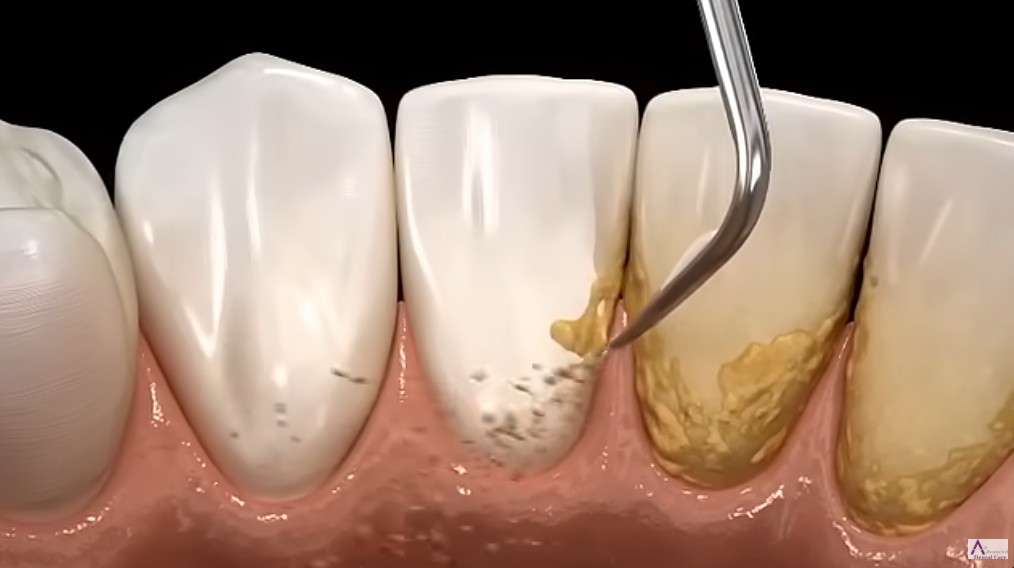 스케일링의 과정 플라그를 미세 초음파가 달린 제거기로 제거하고 있다 (출처 Advanced Dental Care)