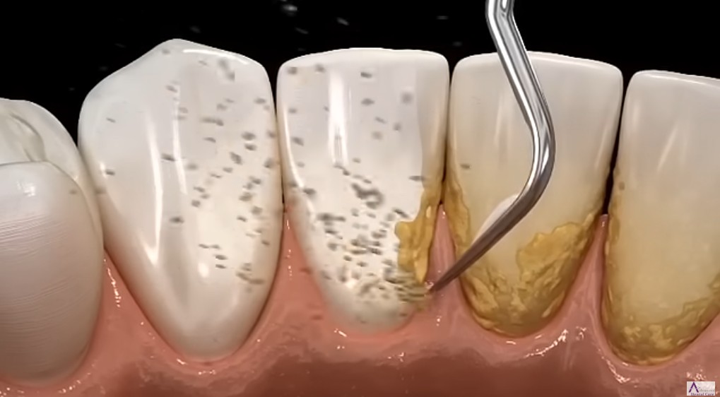 스케일링의 과정 플라그가 사이사이 제거하고 있는 중 (출처 Advanced Dental Care)