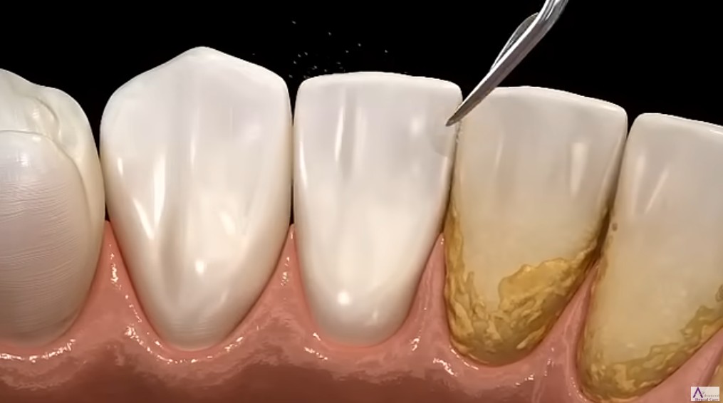 스케일링의 과정 플라그가 다 제거된 깨끗한 치아 (출처 Advanced Dental Care)