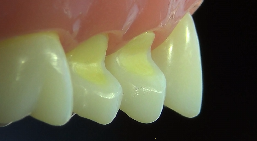 "A dental photograph that compares a healthy tooth with a tooth suffering from cervical abrasion side-by-side, clearly demonstrating the wear and indentation at the gum line. Clinical lighting, detailed and informative.