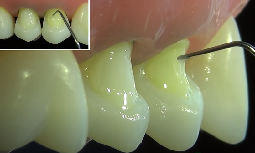 A photograph of a dental professional applying a composite filling to a tooth with cervical abrasion in a dental clinic setting. The focus is on the procedure and the restoration process. Clear and professional, realistic setting.