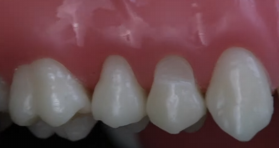 An in-mouth photograph showing teeth with various degrees of cervical abrasion, using a dental mirror for a patient's point of view. The photo should be clear, focusing on the damaged areas at the gum line. Natural lighting.