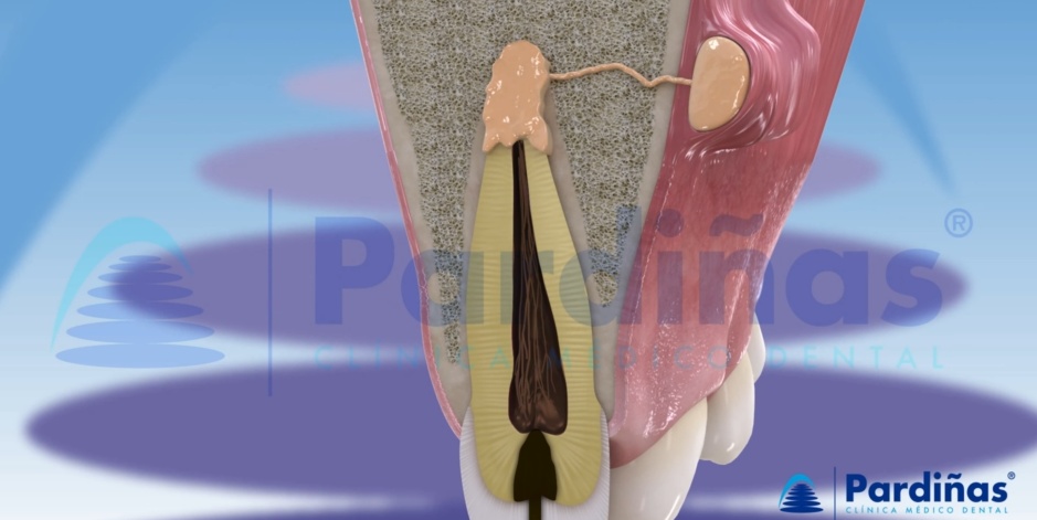 A visual showing what periodontal disease on a gum line that has recession on the tooth and is causing dental abscesses