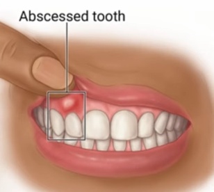 가장 일반적인 표현으로, 잇몸에 발생한 고름 주머니를 의미합니다.