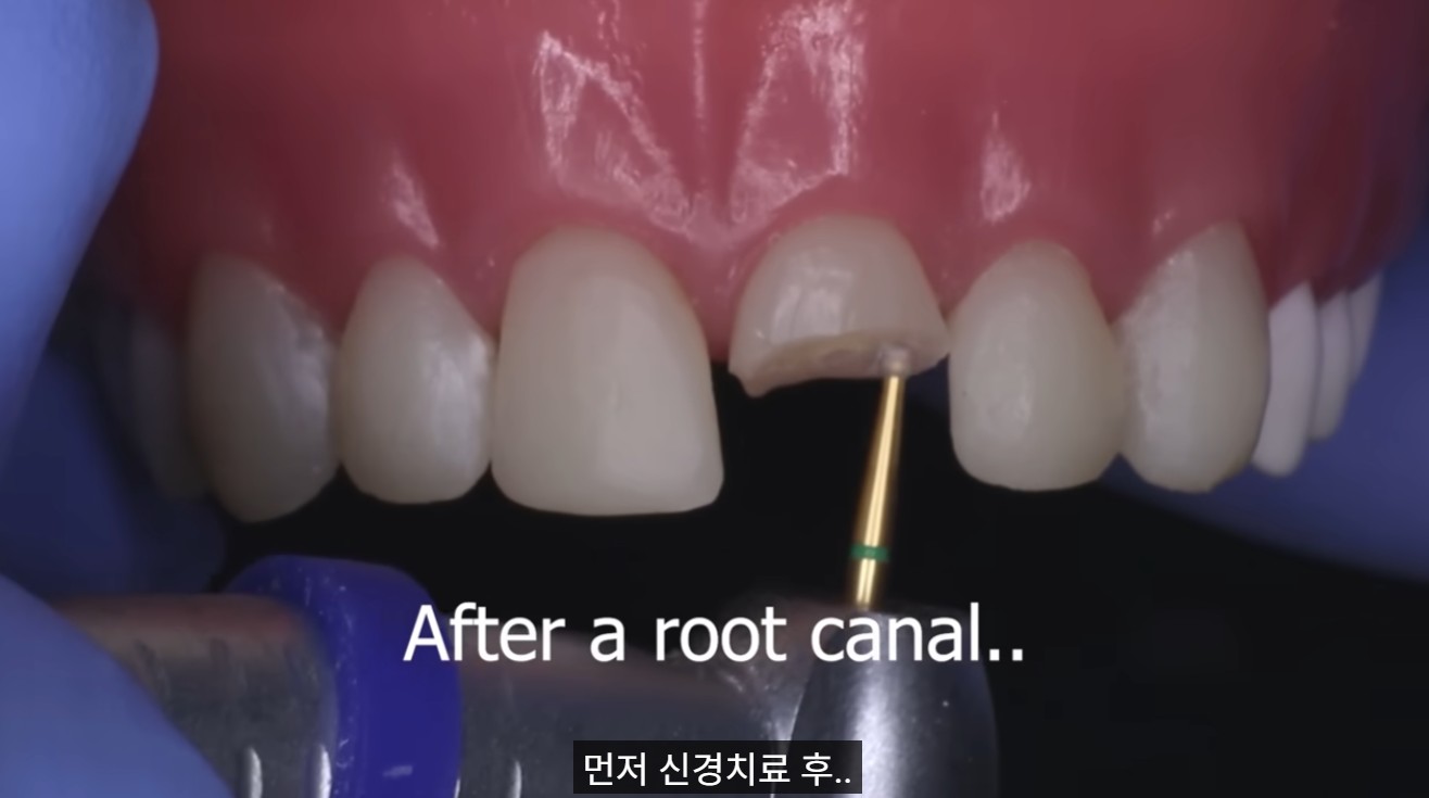 드림연합치과_앞니_파절 (1) 울산 드림연합치과에서 사고로 인한 앞니 파절 치료