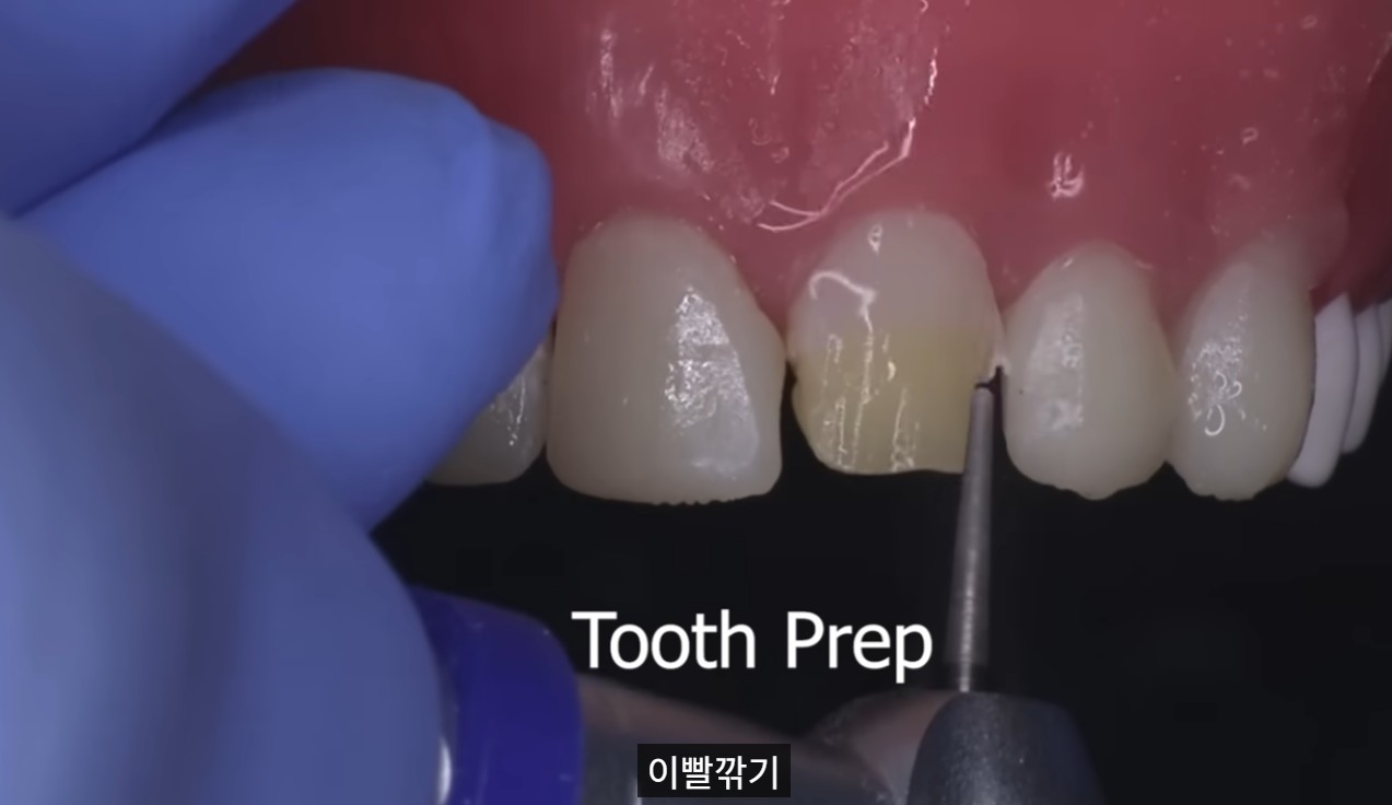 드림연합치과_앞니_파절 (10) 감염된 신경을 제거하는 **신경치료(근관치료)**를 먼저 시행