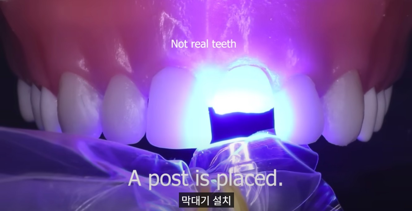 드림연합치과_앞니_파절 (3) 깨진 치아 조각 찾기