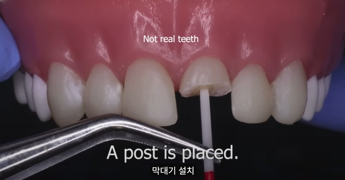 드림연합치과_앞니_파절 (4) 치아 일부가 깨져나가 시린 증상의 신경치료