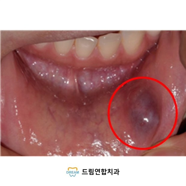 점액낭종제거술1 (1) 점액낭종의 실제 사진이며, 작은 침샘(소타액선)의 관이 막히거나 손상되어 침(타액)이 제대로 배출되지 못하고 주변 조직으로 새어 나와 물혹처럼 고여 있는 상태