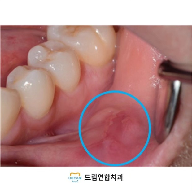 점액낭종제거술1 (2) 점액낭종제거술 시행 후 회복된 상태. 깨끗하게 회복 된 환자의 모습