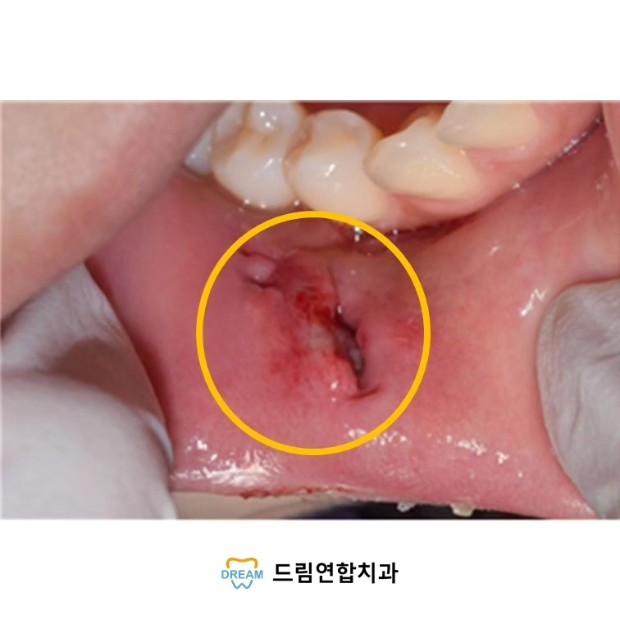 점액낭종제거술1 (3) 점액 낭종 제거술을 시행 후 꼬맨상태 드림연합치과 실제 사례