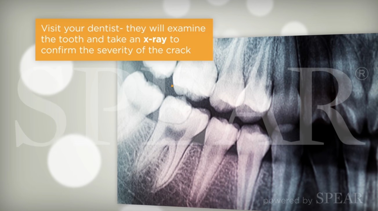치아 균열 Xray사진