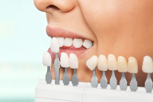 close-up-portrait-young-woman-checking-selecting-color-teeth (2) 라미네이트 시술 전 치아 색상을 확인하는 모습 (울산 드림연합치과)