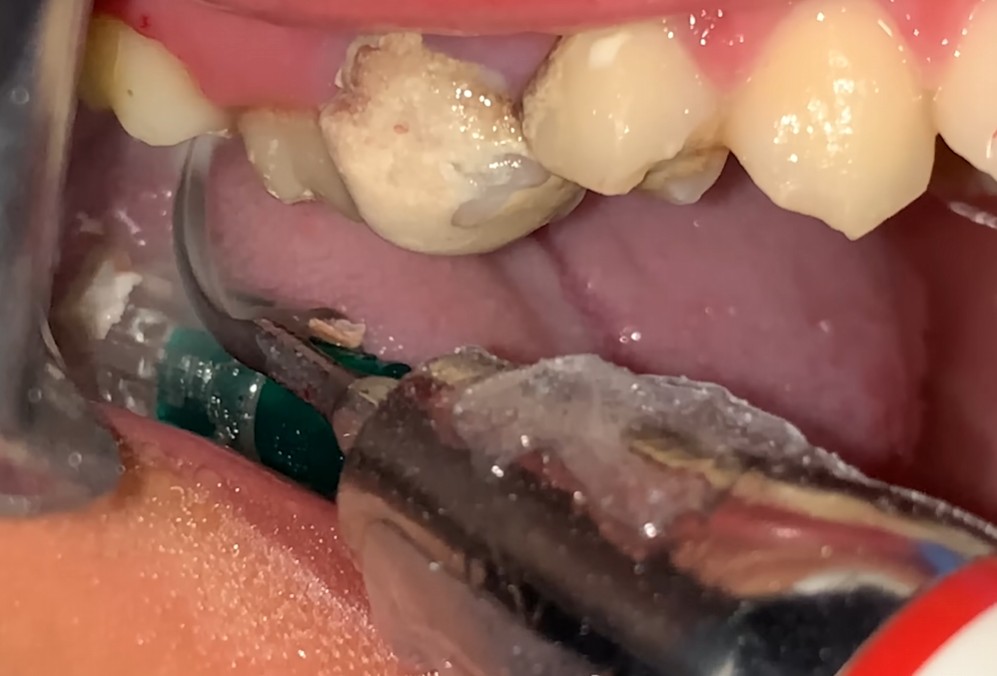 스케일링 잇몸치료 (10) 스케일링을 하고 있는 실제 사진 - 출처 : 유튜브 - Scaling. | Dentist | Dokter Gigi Tri Putra