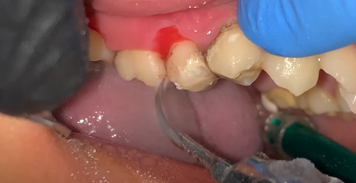 스케일링을 하여 치석이 제거 - 출처 : 유튜브 - Scaling. | Dentist | Dokter Gigi Tri Putra
