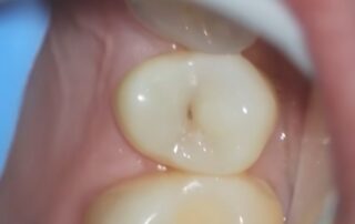 A person looking closely into a bathroom mirror with a slightly worried expression, using a finger to point at a small black dot on their molar tooth. The focus is on their concern and the discovery.