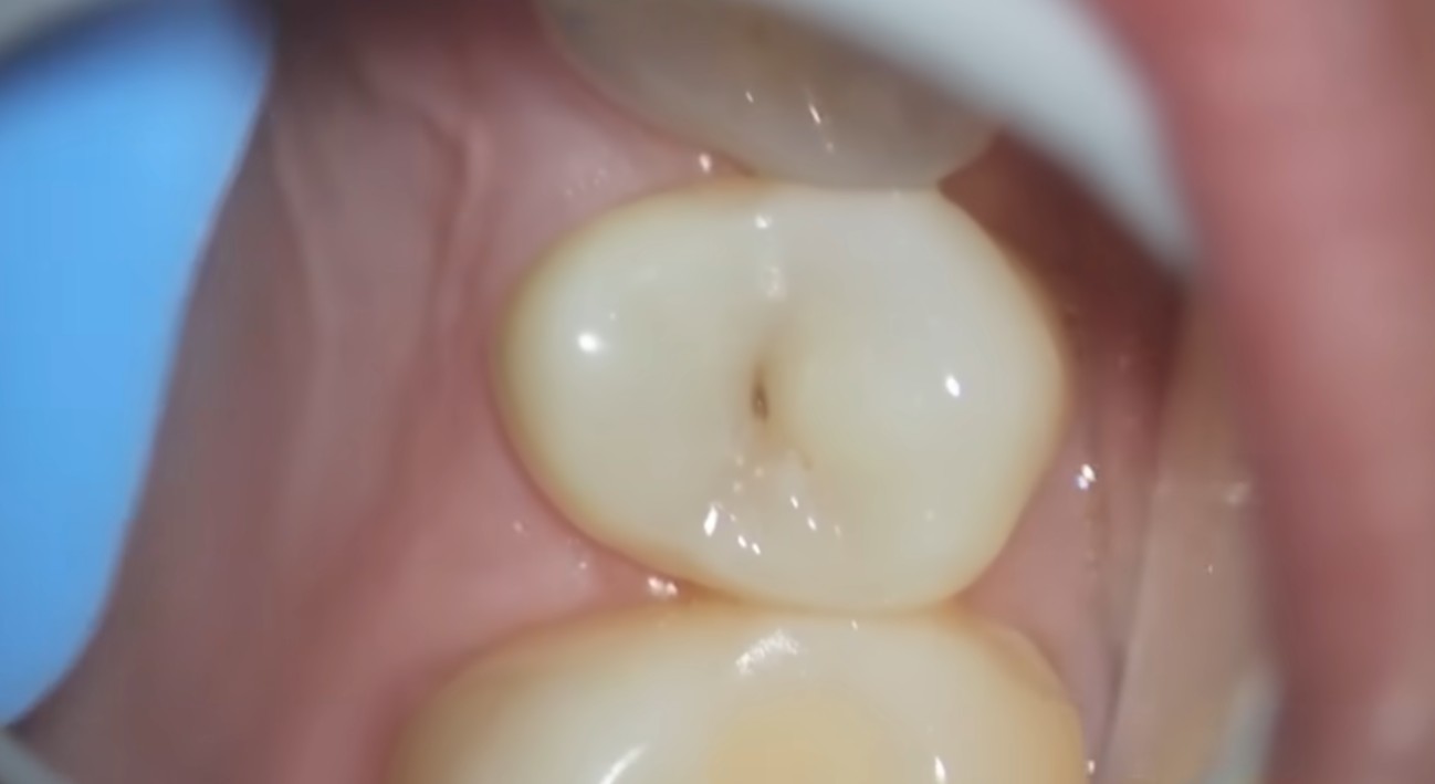A person looking closely into a bathroom mirror with a slightly worried expression, using a finger to point at a small black dot on their molar tooth. The focus is on their concern and the discovery.