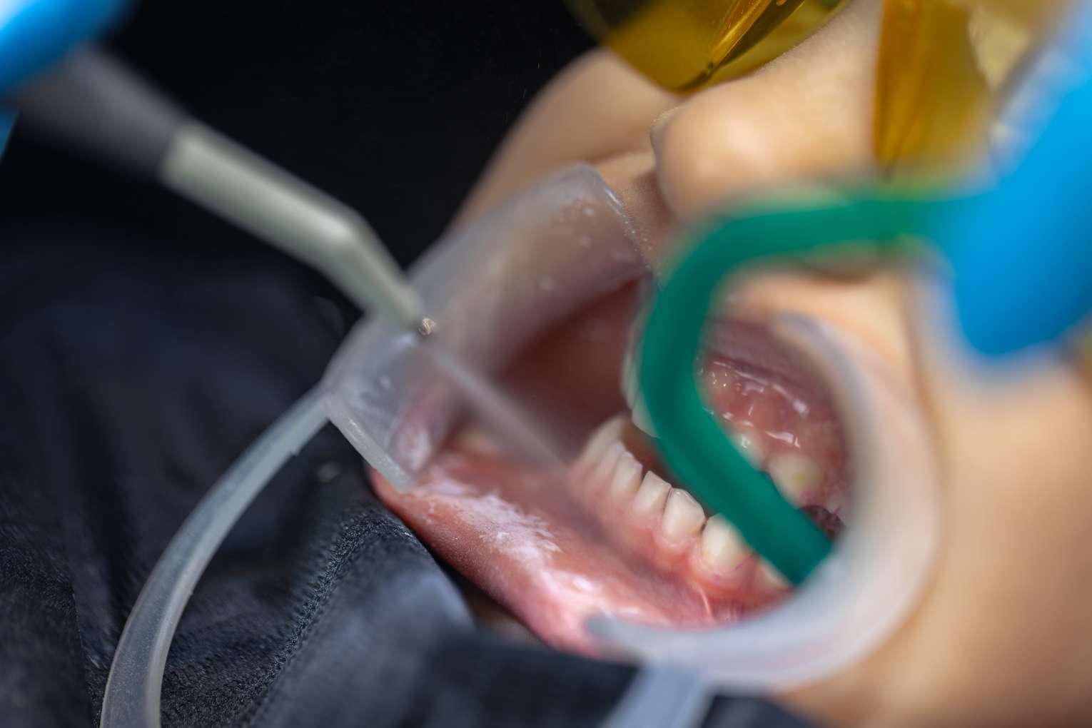 closeup-childs-mouth-dental-treatment-dentistry-dental-treatment 울산 드림연합치과에서 어린이 충치 치료받는 모습 클로즈업