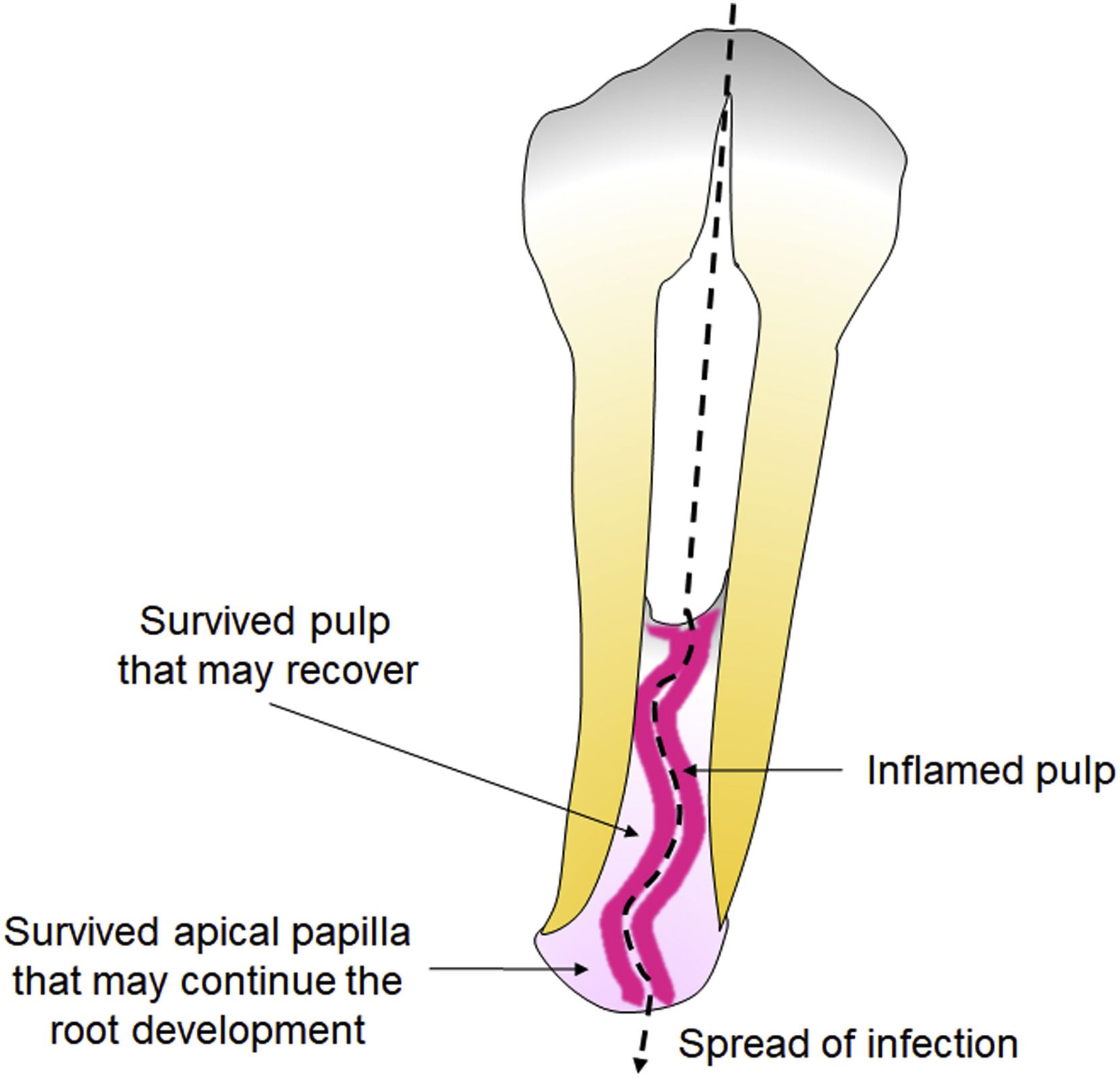 치외치 (1) Dens evaginatus - The Journal of the American Dental Association