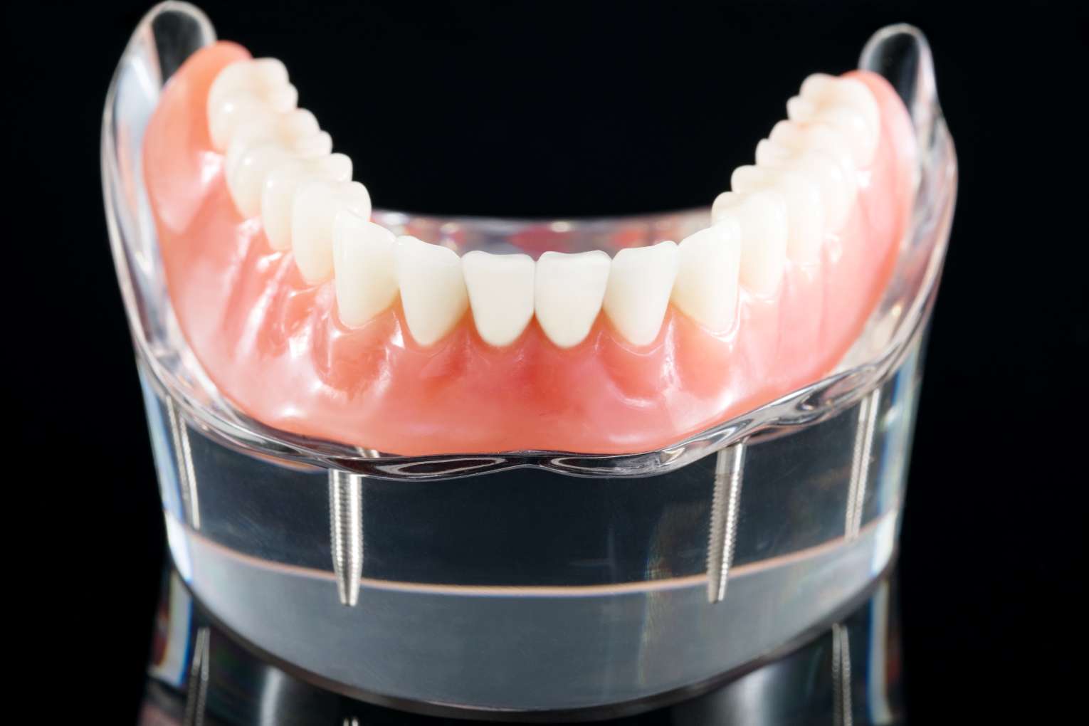 teeth-model-showing-implant-crown-bridge-model-dental-demonstration-teeth-study-teach-model (3) 드림연합치과 틀니 참조 사진