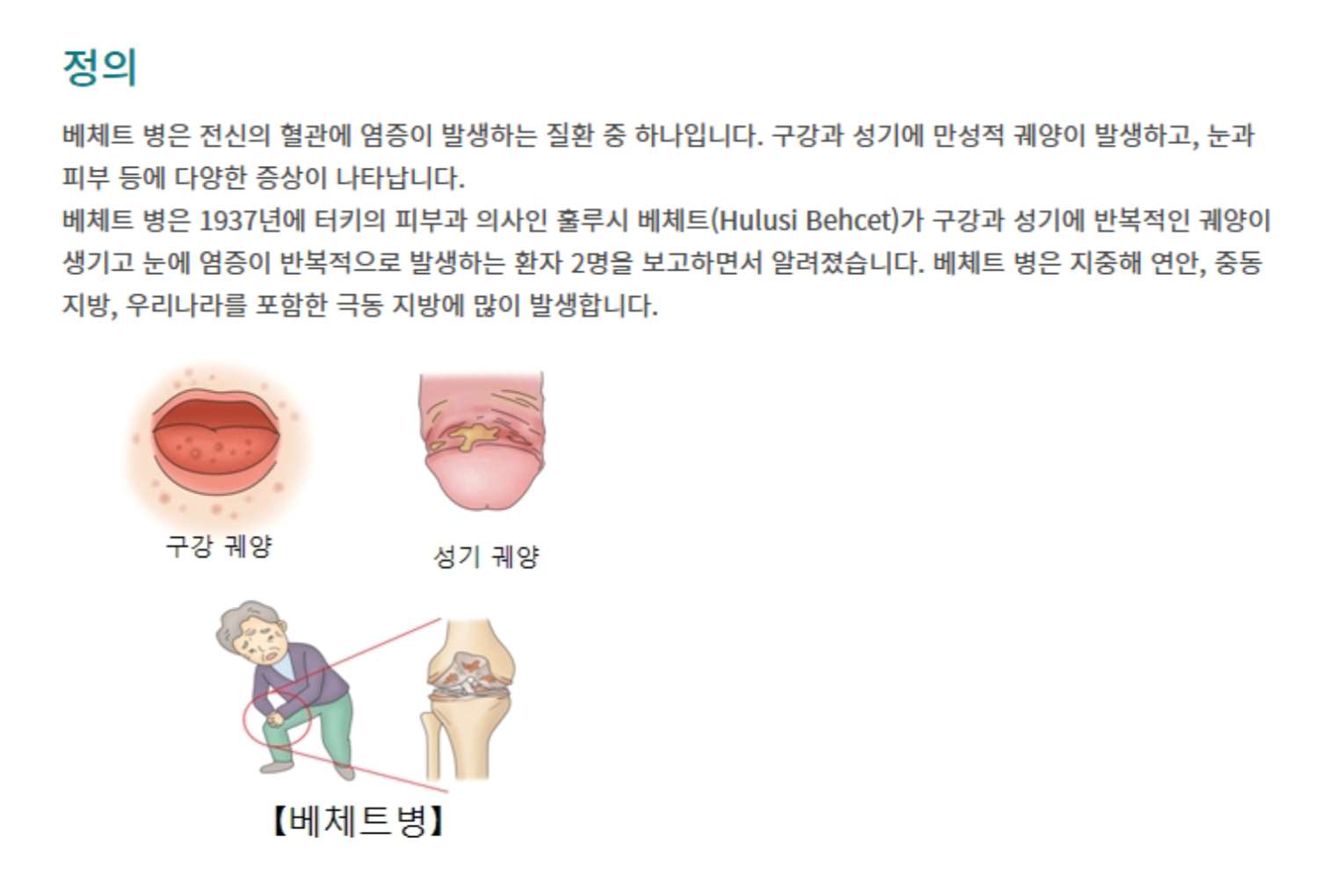 베첸트병 베체트 병은 전신의 혈관에 염증이 발생하는 질환 중 하나입니다. 서울아산병원 참조이미지
