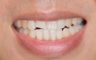 환자의 삐뚤어진 치아의 이유를 원인과 해결
