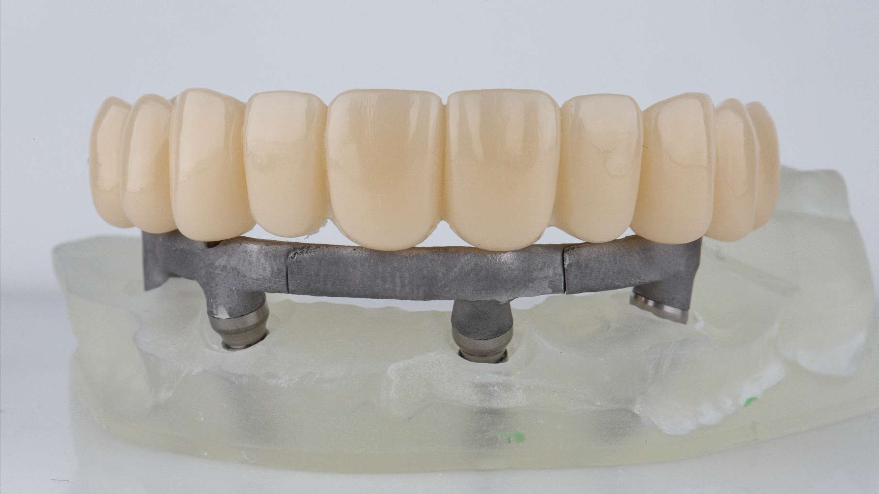 dental-prosthetic-top-jaw-metal-bridge