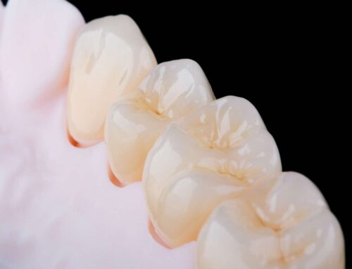 [울산 치과] 치아 브릿지 수명, 얼마나 될까? 교체 시기와 신호 (드림연합치과)