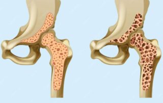 일반뼈와 골다공증 뼈를 비교한 이미지